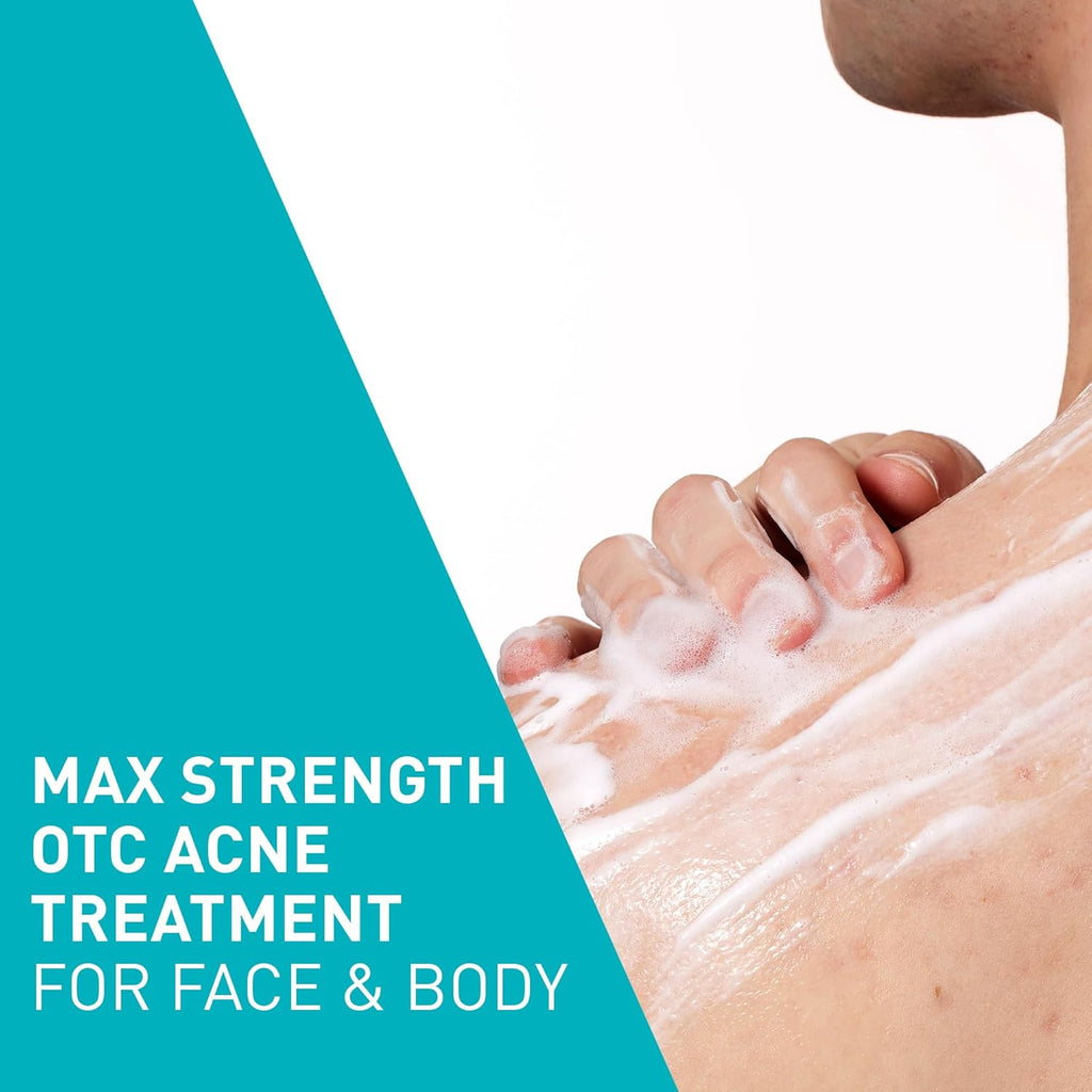 CeraVe Acne Foaming Cream Wash with 10% Benzoyl Peroxide. Treats breakouts on face & body, gentle with Niacinamide & Hyaluronic Acid.