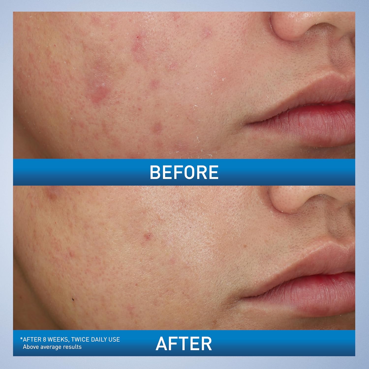 CeraVe Acne Foaming Cream Wash with 10% Benzoyl Peroxide. Treats breakouts on face & body, gentle with Niacinamide & Hyaluronic Acid.