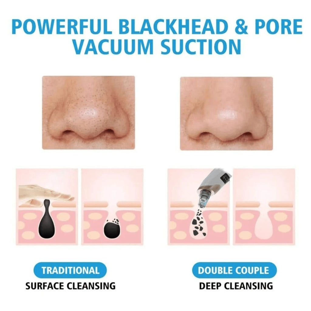 Electric Blackhead Vacuum Remover - Pore Cleanser & Pimple Sucker for Spa-Quality Facial at Home