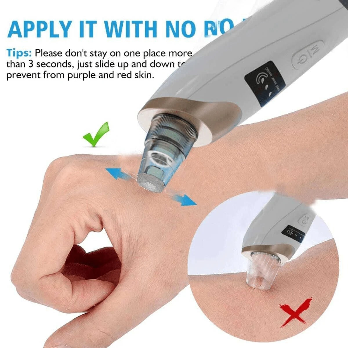 Electric Blackhead Vacuum Remover - Pore Cleanser & Pimple Sucker for Spa-Quality Facial at Home